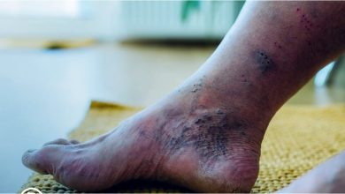 صورة وسط ارتفاع المقلق لحالات البتر..التأكيد على الفحص المبكر لحالات مرض القدم السكري 