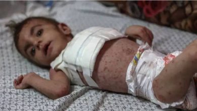 صورة وسط انتشار الحشرات والقوارض والبعوض وتلوث الماء.. أمراض جلدية خطيرة تفتك بأطفال غزة